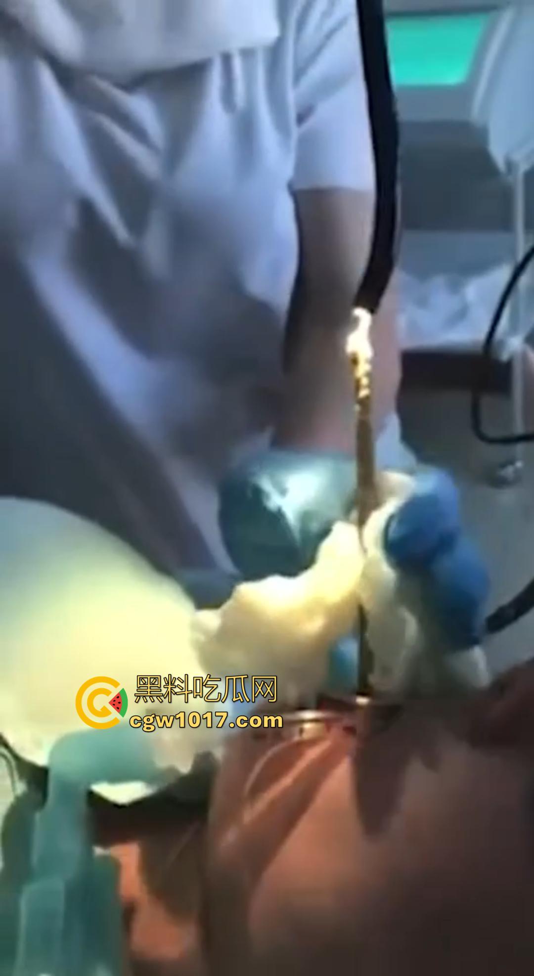 俄罗斯医院活拽1米毒蛇!女患者吞蛇卵孵化钻喉,医生手抖拽出瞬间到处乱窜!-2