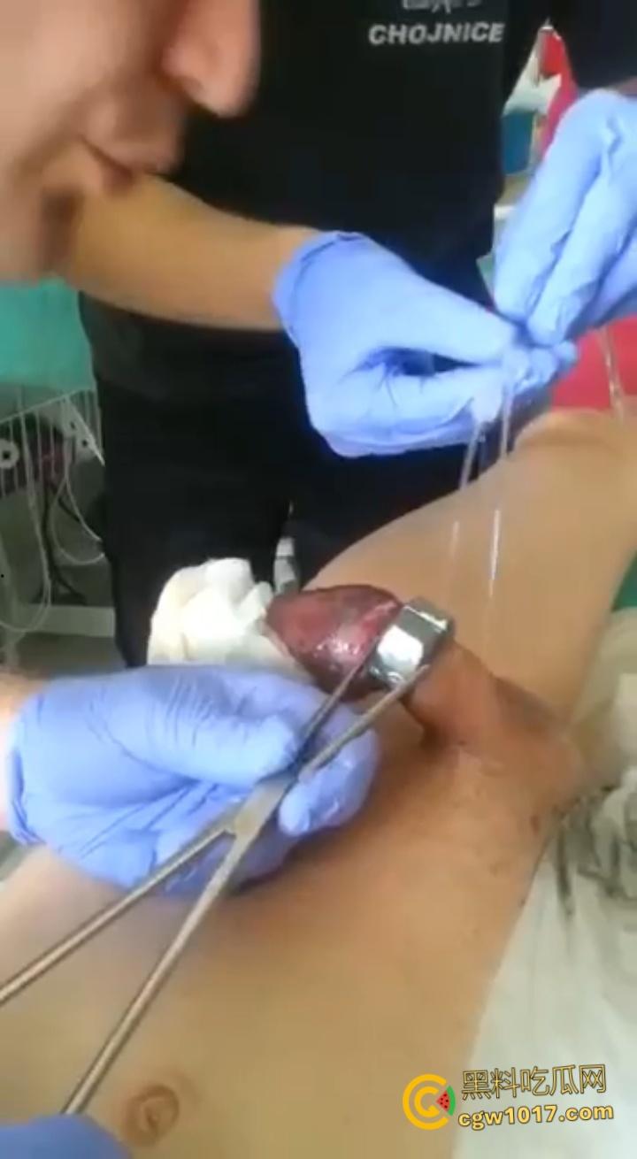 小说照进现实，男子追求刺激螺母自慰，勃起后被螺母卡住，消防人员和医生同时出动，解救被困阴茎 ！-7